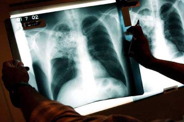 Franca inicia ações de prevenção de casos de tuberculose