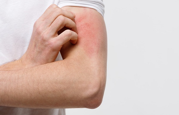 Aumento de atendimentos e internações por doenças da pele 