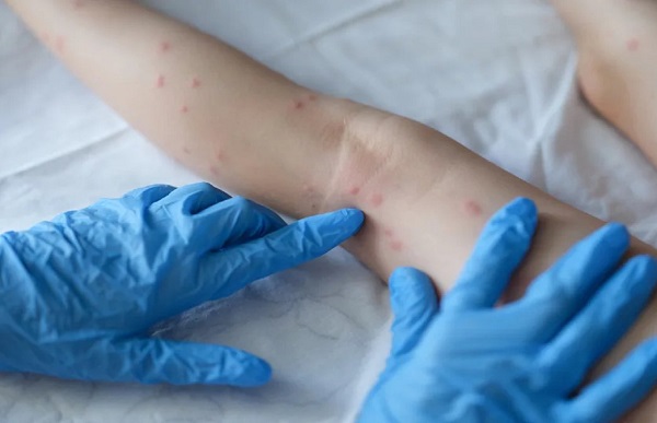 Entenda a varíola dos macacos, principais sintomas e formas de prevenção