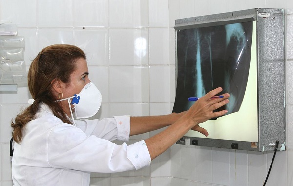 Brasil registra 78 mil novos casos de tuberculose em 2022